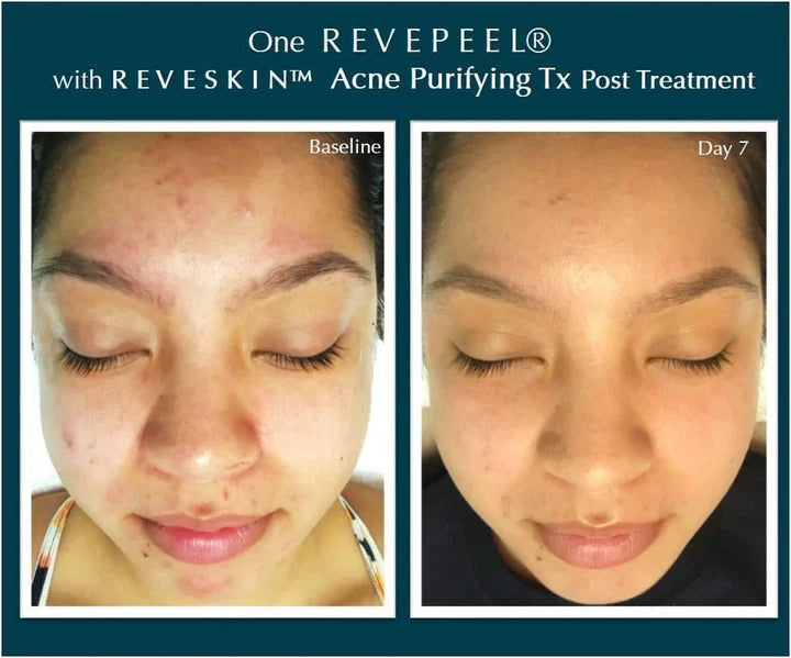 Acne Purifying TX Trial System